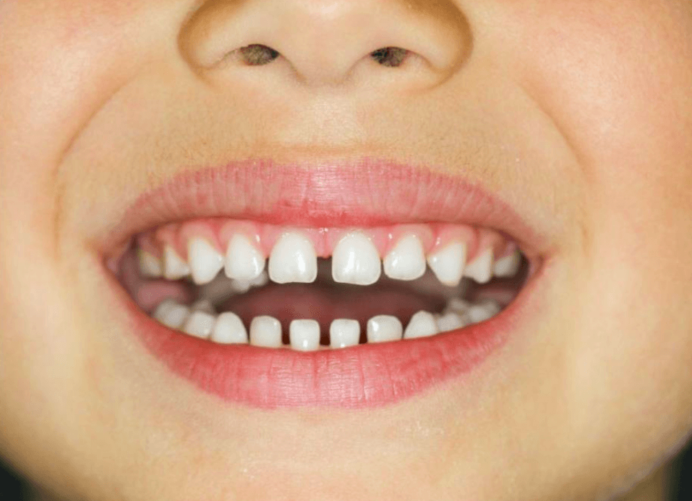 فاصله بین دندانها و راههای بر طرف کردن آن